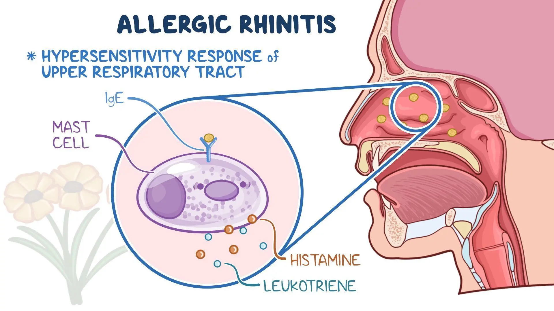 Allergic rhinitis: Video & Meaning | Osmosis
