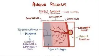 Angina pectoris