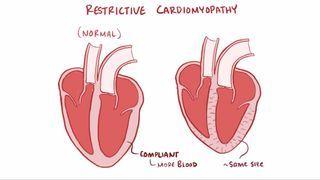 Restrictive cardiomyopathy