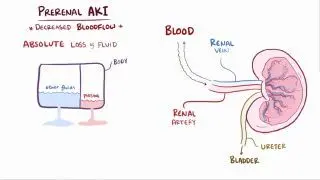 Prerenal azotemia