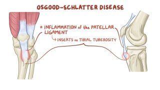 Osgood-Schlatter disease (traction apophysitis)