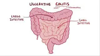 Ulcerative colitis