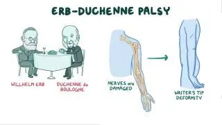 Erb-Duchenne palsy