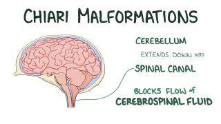 Chiari malformation