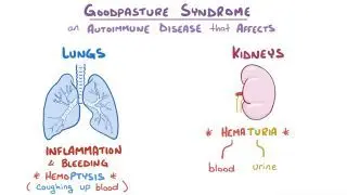 Goodpasture syndrome