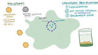 Gallstones