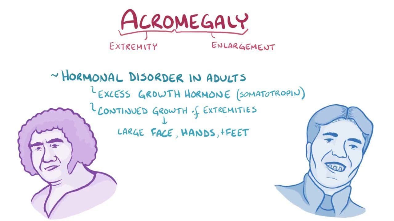 Acromegaly Definition And Meaning – EIZNJ