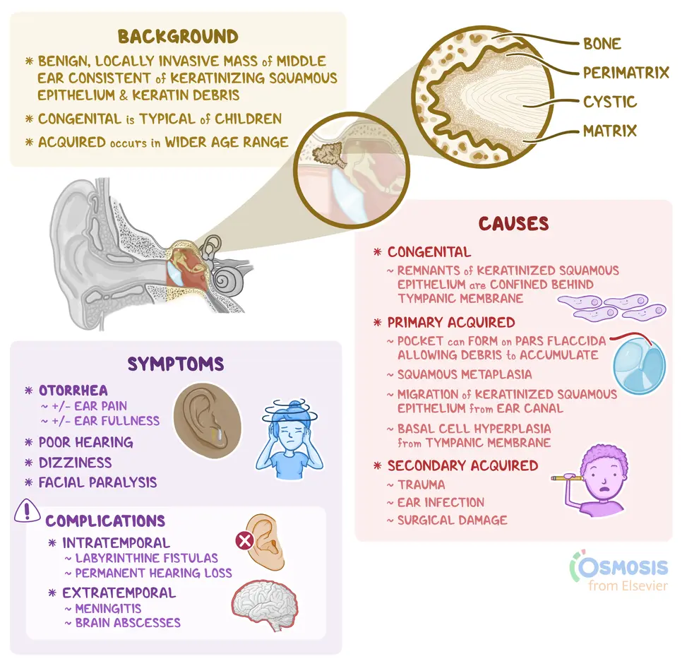 An infographic detailing the background, causes, signs and symptoms, diagnosis, and treatment of cholesteatoma.