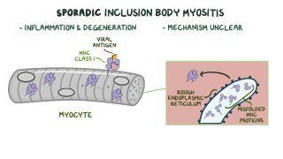 Inclusion body myopathy
