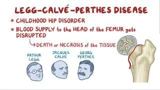 Legg-Calve-Perthes disease