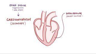Dilated cardiomyopathy