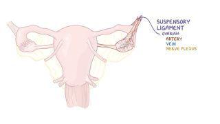 Ovarian cyst