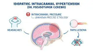 semaglutide intracranial hypertension Idiopathic intracranial hypertension: Video & Meaning