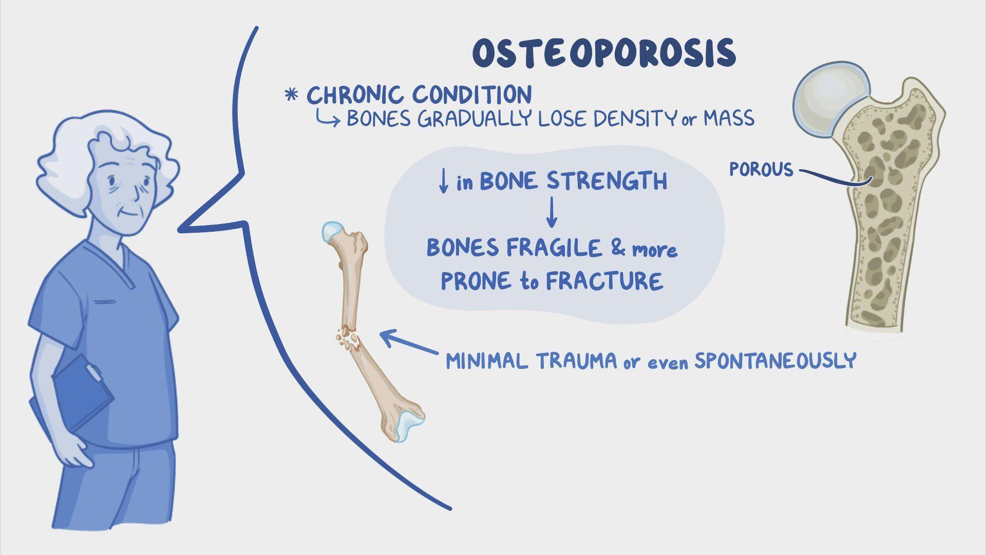 video-osteoporosis-nursing-osmosis
