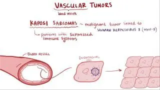 Vascular tumors
