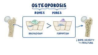 Bone and joint pathology Notes: Diagrams & Download PDF | Osmosis