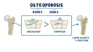 Osteoporosis