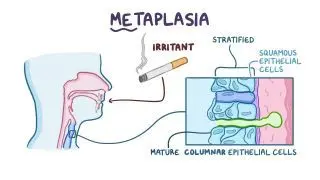 Metaplasia and dysplasia