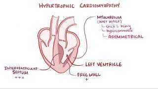 Hypertrophic cardiomyopathy