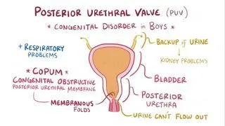 Posterior urethral valves