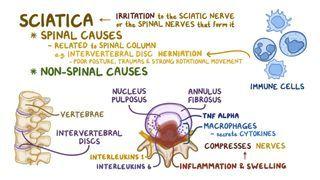 Sciatica