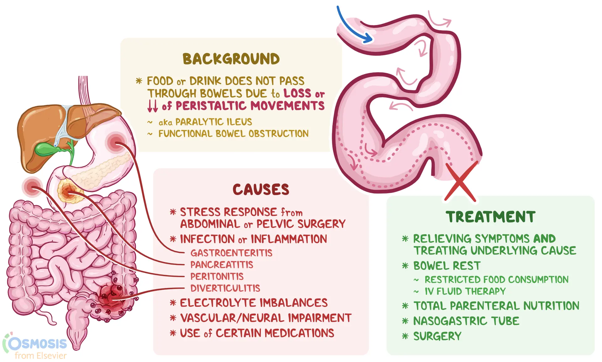 semaglutide intestinal obstruction Adynamic Ileus: What Is It, Symptoms, Treatment, and More