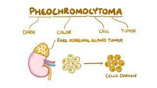 Pheochromocytoma