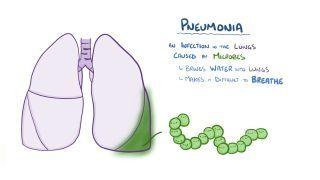 Pneumonia