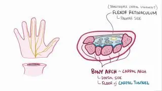 Carpal tunnel syndrome