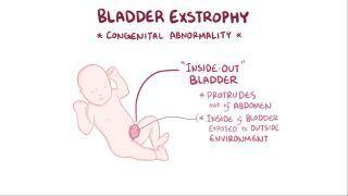 Bladder exstrophy