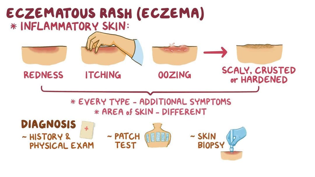 Eczematous rashes: Clinical: Video & Anatomy | Osmosis