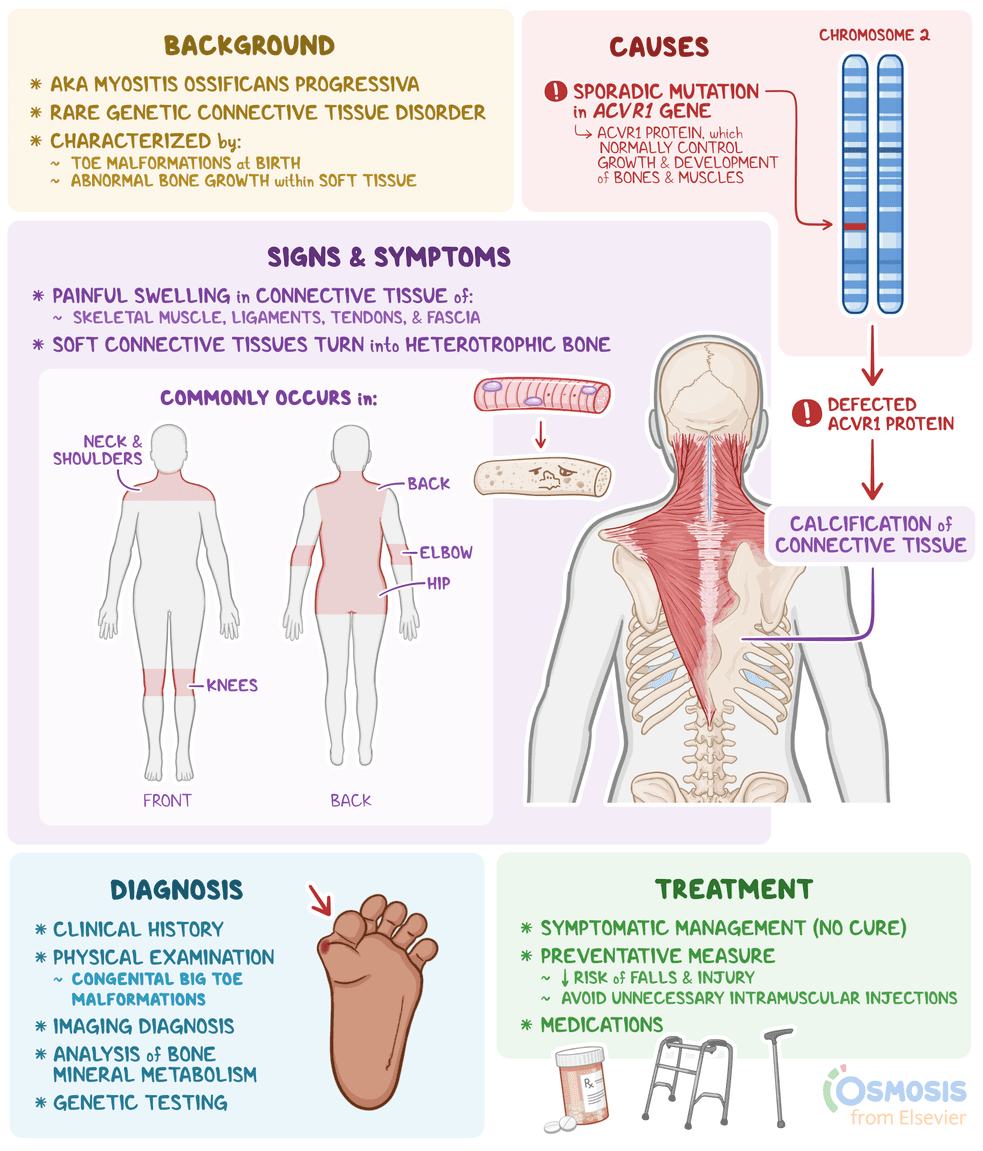 An infographic detailing fibrodysplasia ossificans progressiva