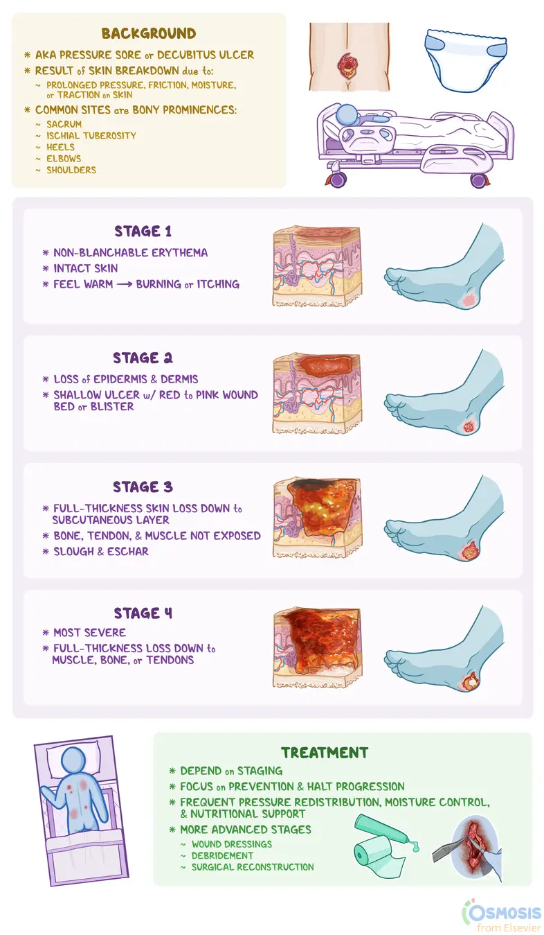 Pressure Ulcer Stages: What Are They, Definition of Stages, and More |  Osmosis