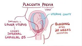 Placenta previa