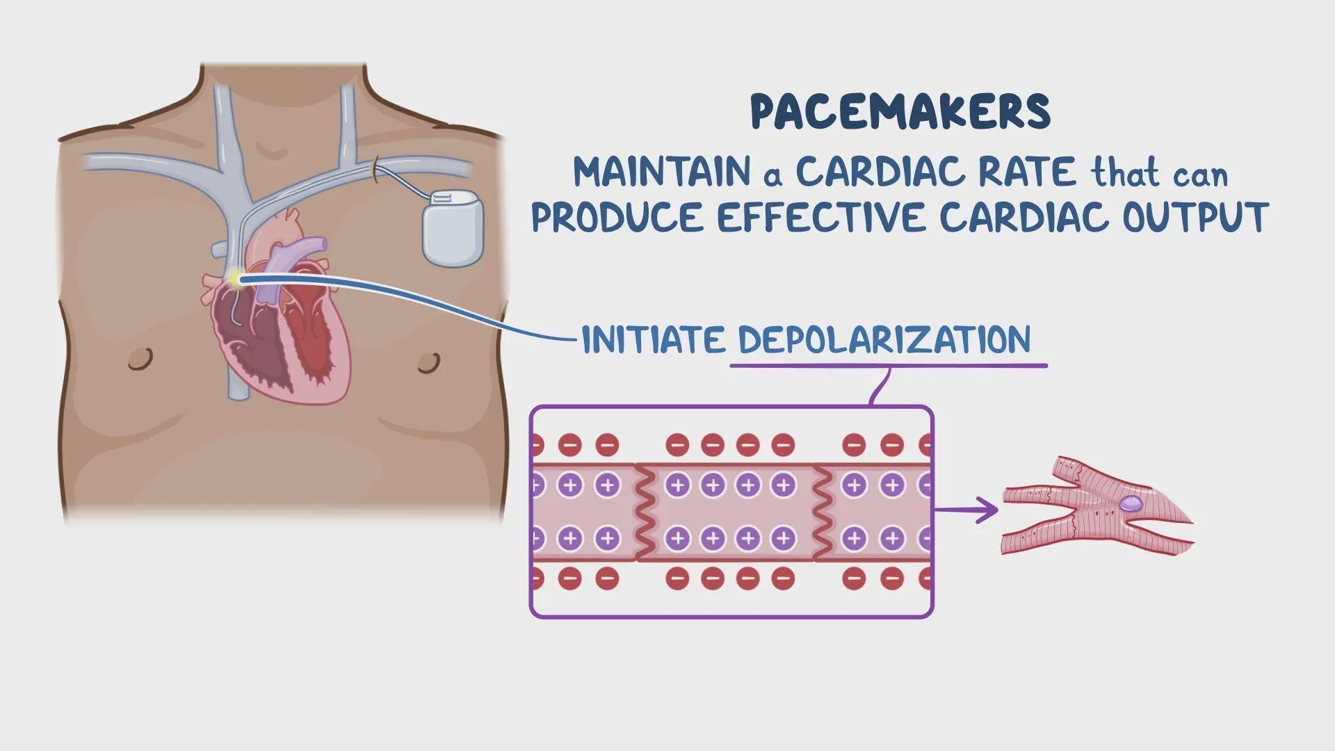 Critical Care - Pacemakers: Vídeo & Anatomía | Osmosis