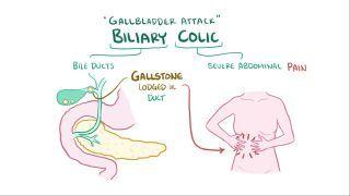 Biliary colic