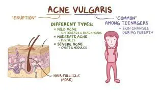 Acne vulgaris