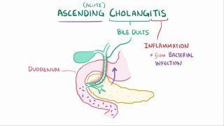 Ascending cholangitis