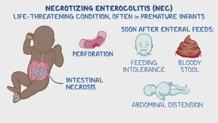 necrotizing-enterocolitis-clinical-sciences-osmosis-video-library