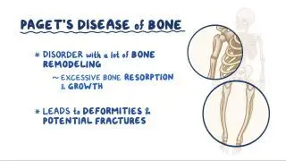 Paget disease of bone