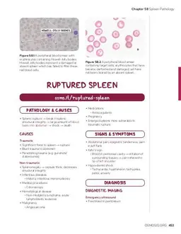 Asplenia: Video, Causes, & Meaning | Osmosis