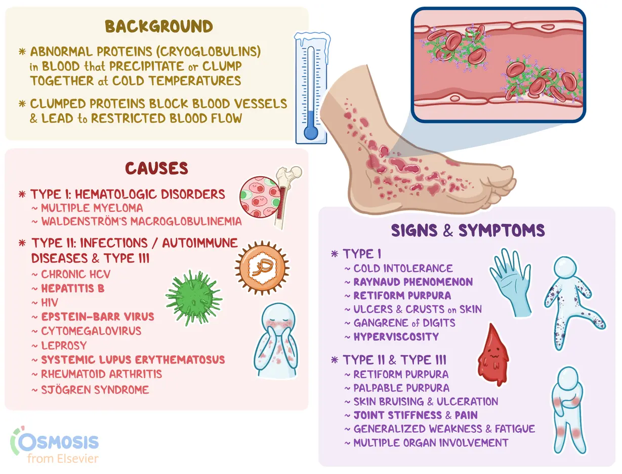 An infographic detailing cryoglobulinemia