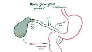 semaglutide cholecystitis Acute cholecystitis: Video, Causes, & Meaning