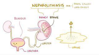 Kidney stones