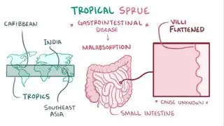 Tropical sprue
