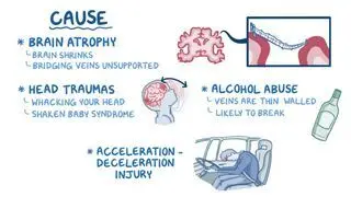 Subdural hematoma