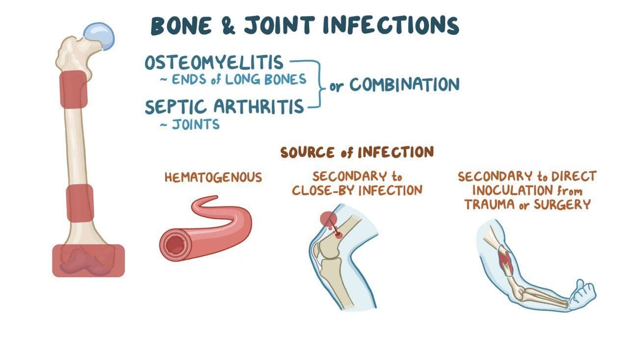 Video: Pediatric bone and joint infections: Clinical | Osmosis