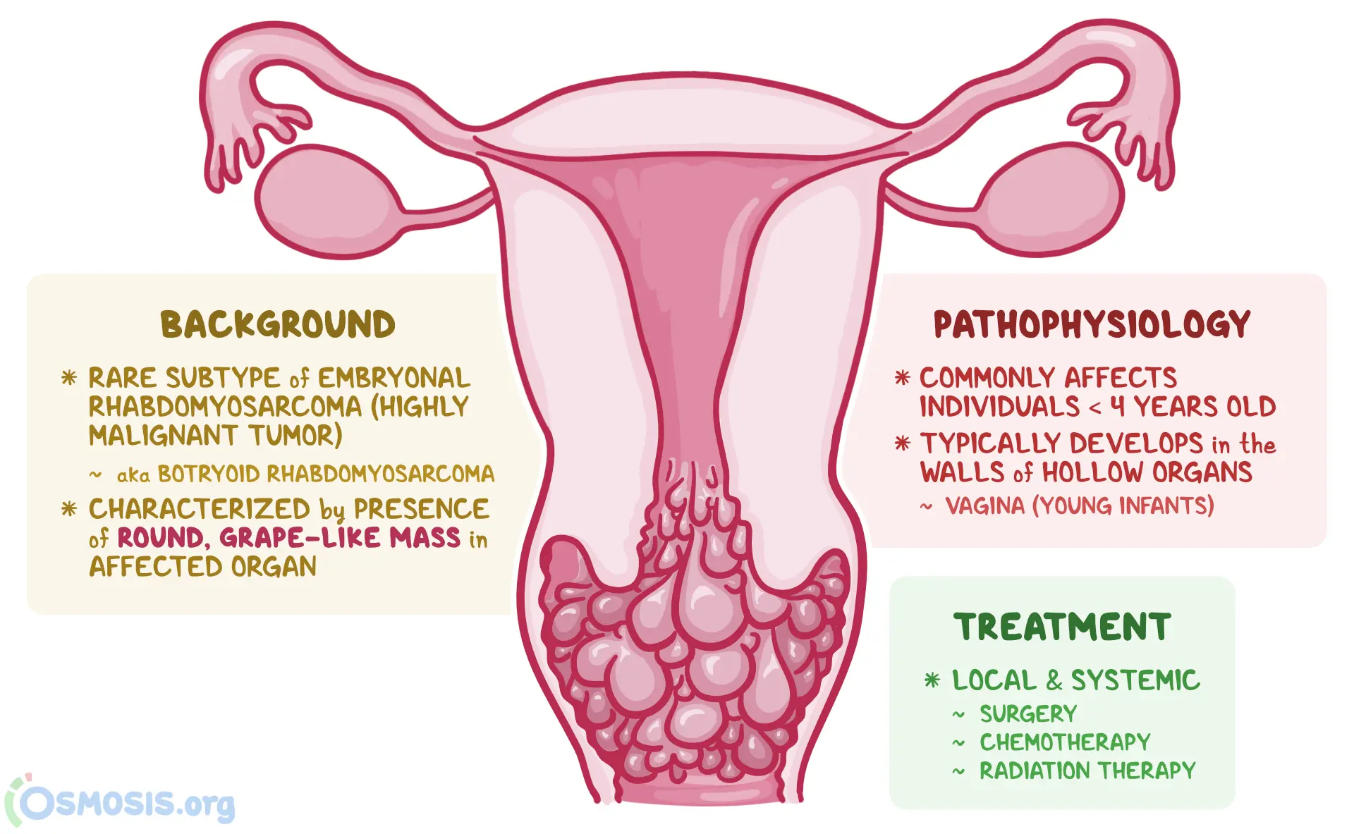 An infographic detailing the causes, signs and symptoms, diagnosis, and treatment of Sarcoma Botryoides