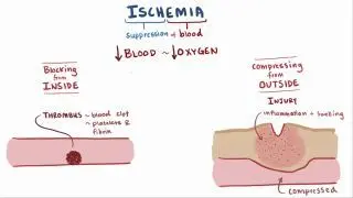 Ischemia