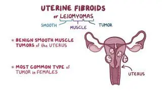 Uterine fibroid